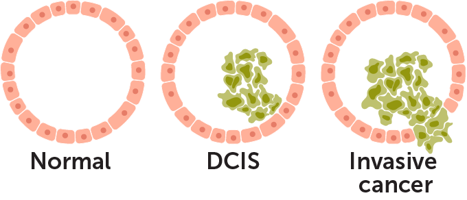 An illustration of the appearance of a normal breast duct (a circle of cells in pink), a duct with DCIS (brown cells growing inside the circle), and invasive cancer (brown cells broken through the circle).